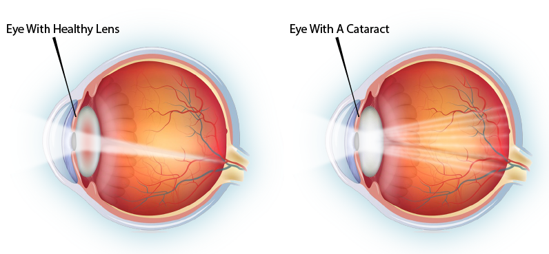 Cataract Surgery Eyecare Associates Of South Tulsa